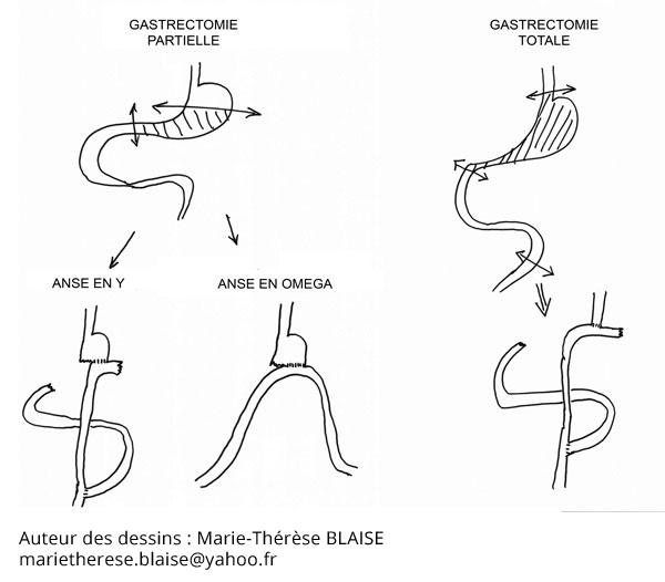 Tumeur estomac, cancer