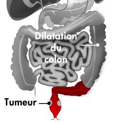 Cancer du rectum