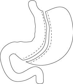 SLEEVE GASTRECTOMY