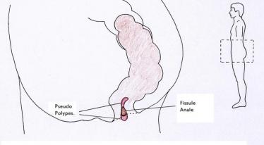  Fissure anal