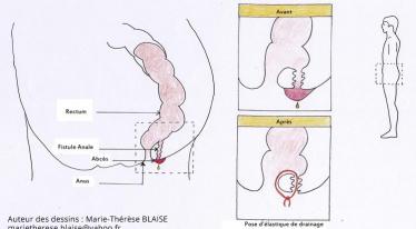 Fistule anale