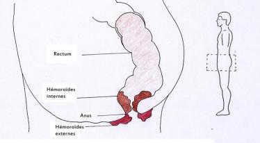 Pathologie hémorroïdaires