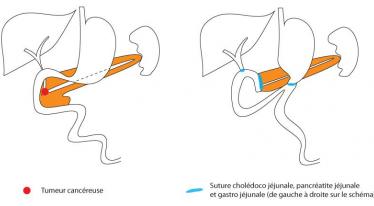 Cancer du pancréas